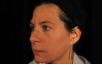 Collagen Induction Therapy results slide 5