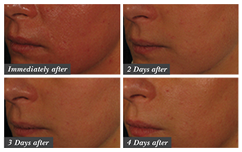 Collagen Induction Therapy results slide 1
