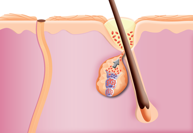 Illustration of a skin cross-section showing a hair follicle with an inflamed sebaceous gland and clogged pore, representing acne formation.