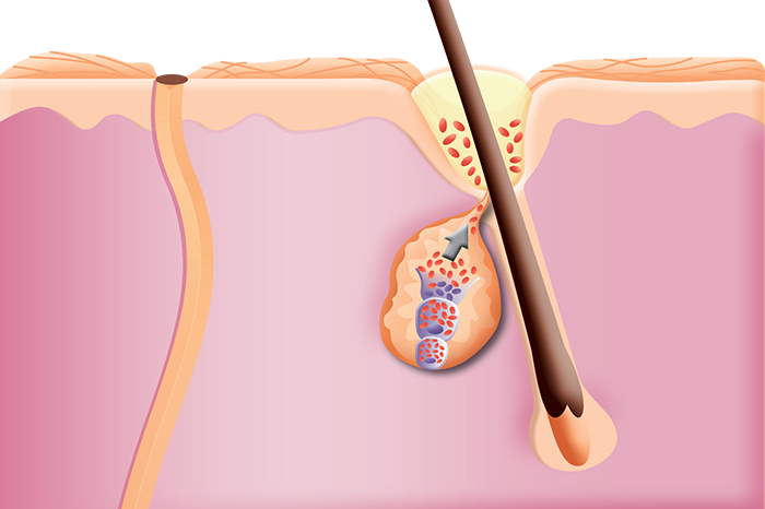 Illustration of a skin cross-section showing a hair follicle with an inflamed sebaceous gland and clogged pore, representing acne formation.