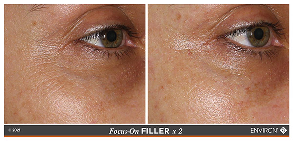 3DSynergé Filler Crème - Before and After 1