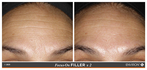 3DSynergé Filler Crème - Before and After 2