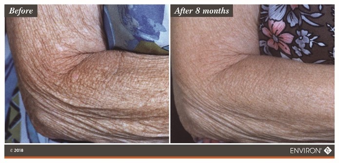 Environ Case Study - Derma-Lac Lotion and Body Oil before and after