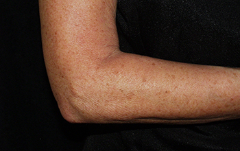 arm-after