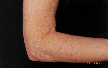 arm-before