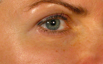 eyes-after-1