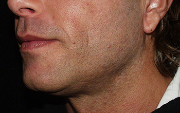 face-after